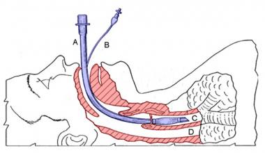 ET tube